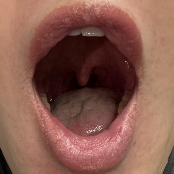 治療6回目