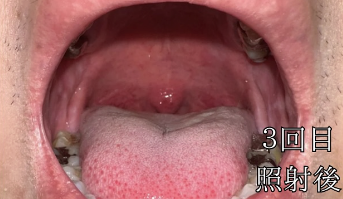 治療3回目