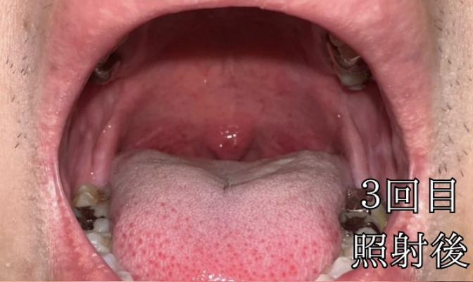 治療3回目