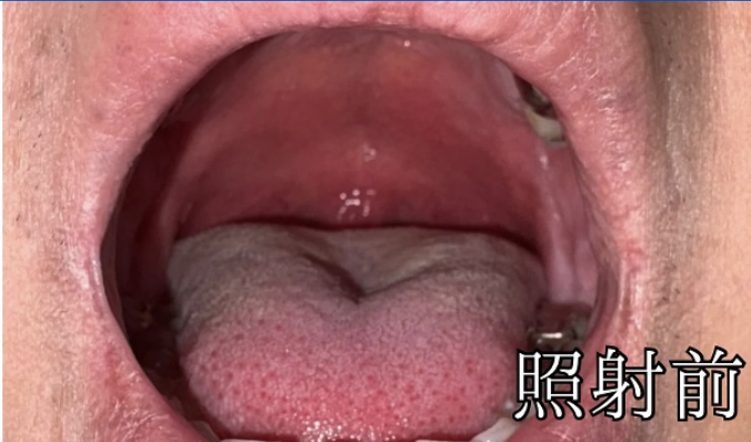 治療前