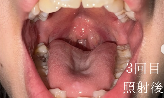 治療3回目
