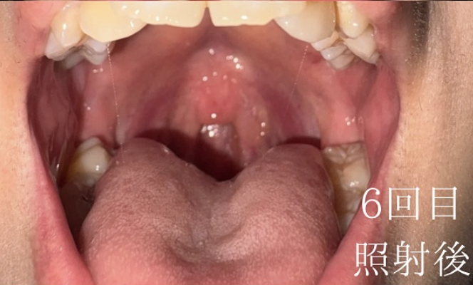 治療6回目