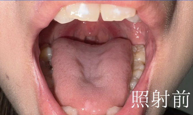 治療前